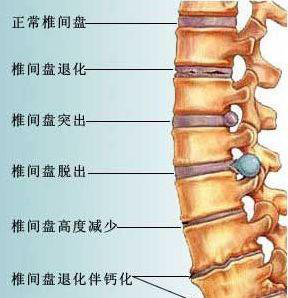 老年人腰椎退行性骨关节病如何治疗(3)低视力康复主要是指导患者配用